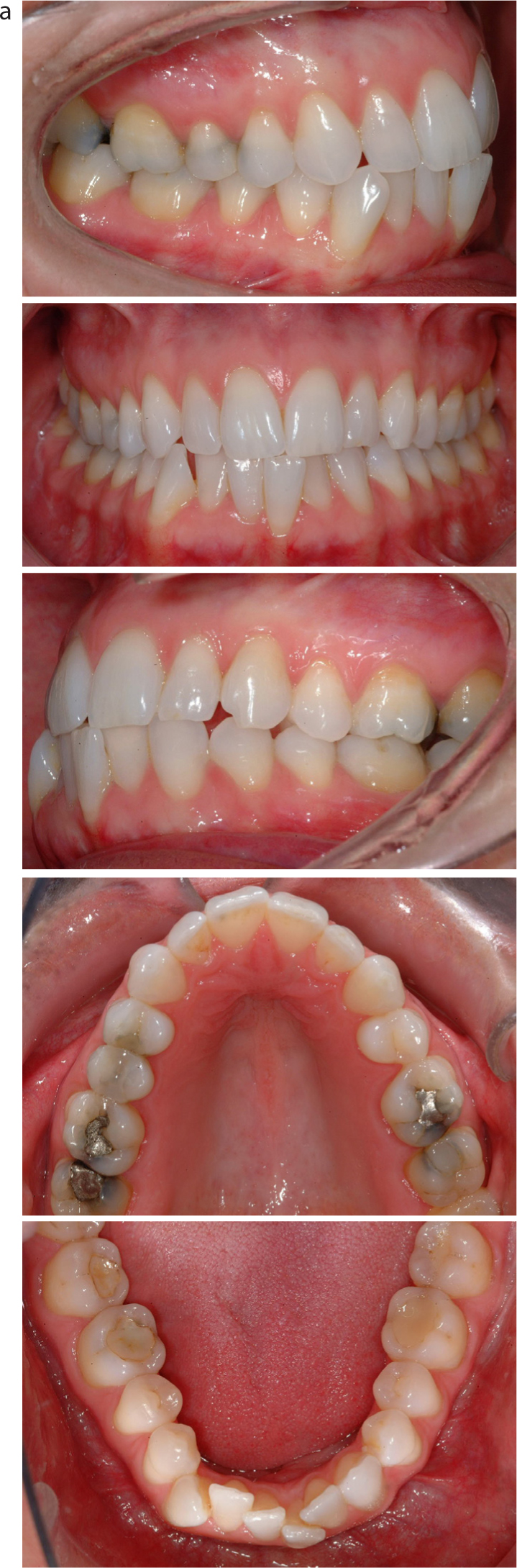 orthodontic alignment of teeth part 3