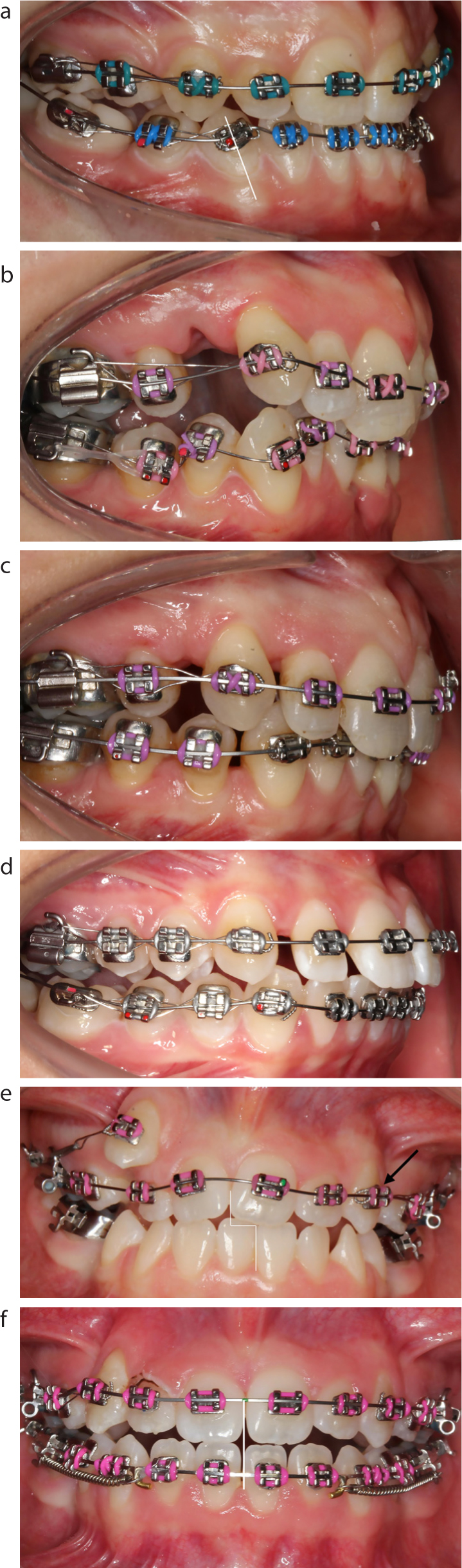 Ligation ties in orthodontics