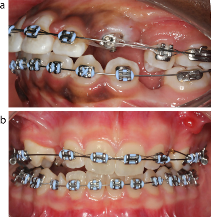 Ligation ties in orthodontics