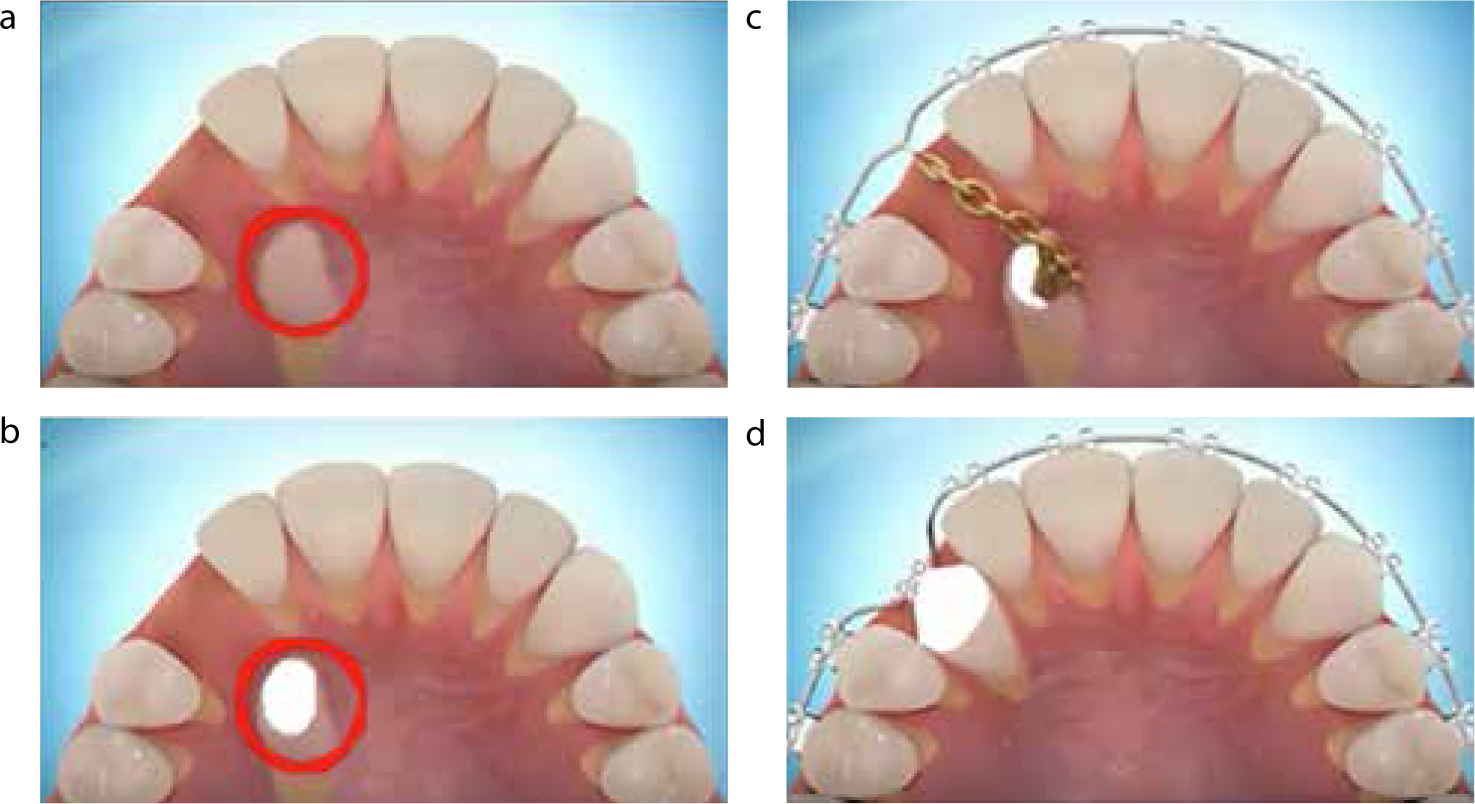 Orthodontic Update Open or closed exposure for palatally