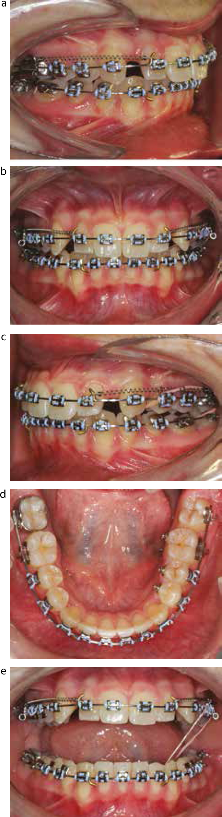 Cross-elastics to assist in expansion of the maxillary arch.