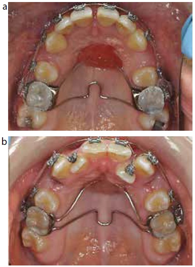 palatal holding arch