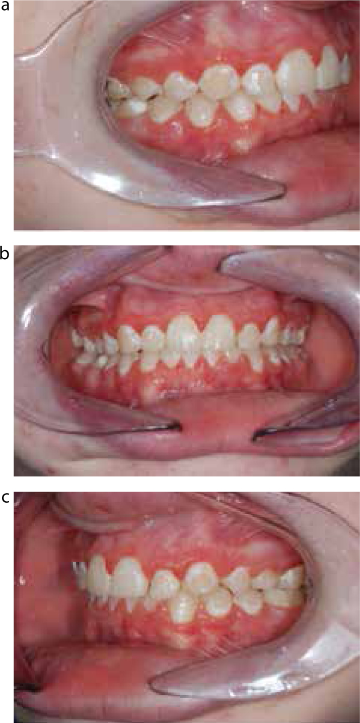 The influence of age and orthodontic debonding on the prevalence